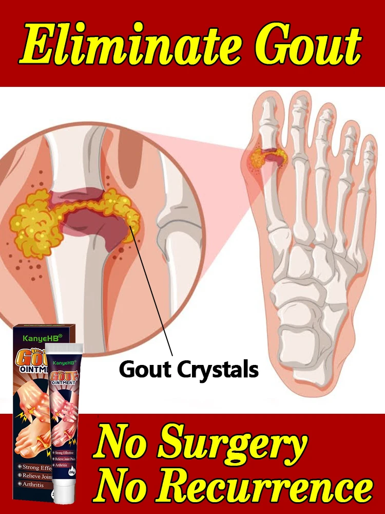 

Gout cream rheumatoid arthritis lowering uric acid