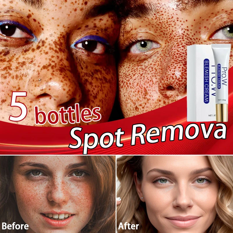 7Days Whitening Freckle Cream Effective Remove Melasma Dark Spot Fade Melanin Anti-Pigmentation Improve Dullness Korean SkinCare
