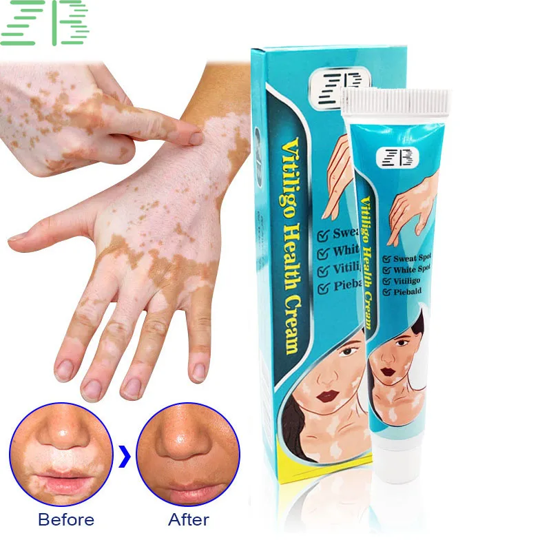 

ZB 20g Herbal Extract Vitiligo Ointment Remove Ringworm White Spot Removal Skin White Spot Leukoplakia Disease Treatment Cream