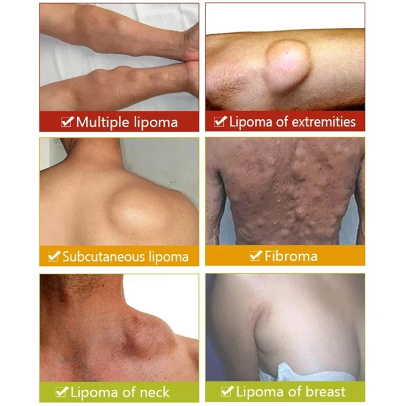 Крем Lipoma для удаления жира 20 г
