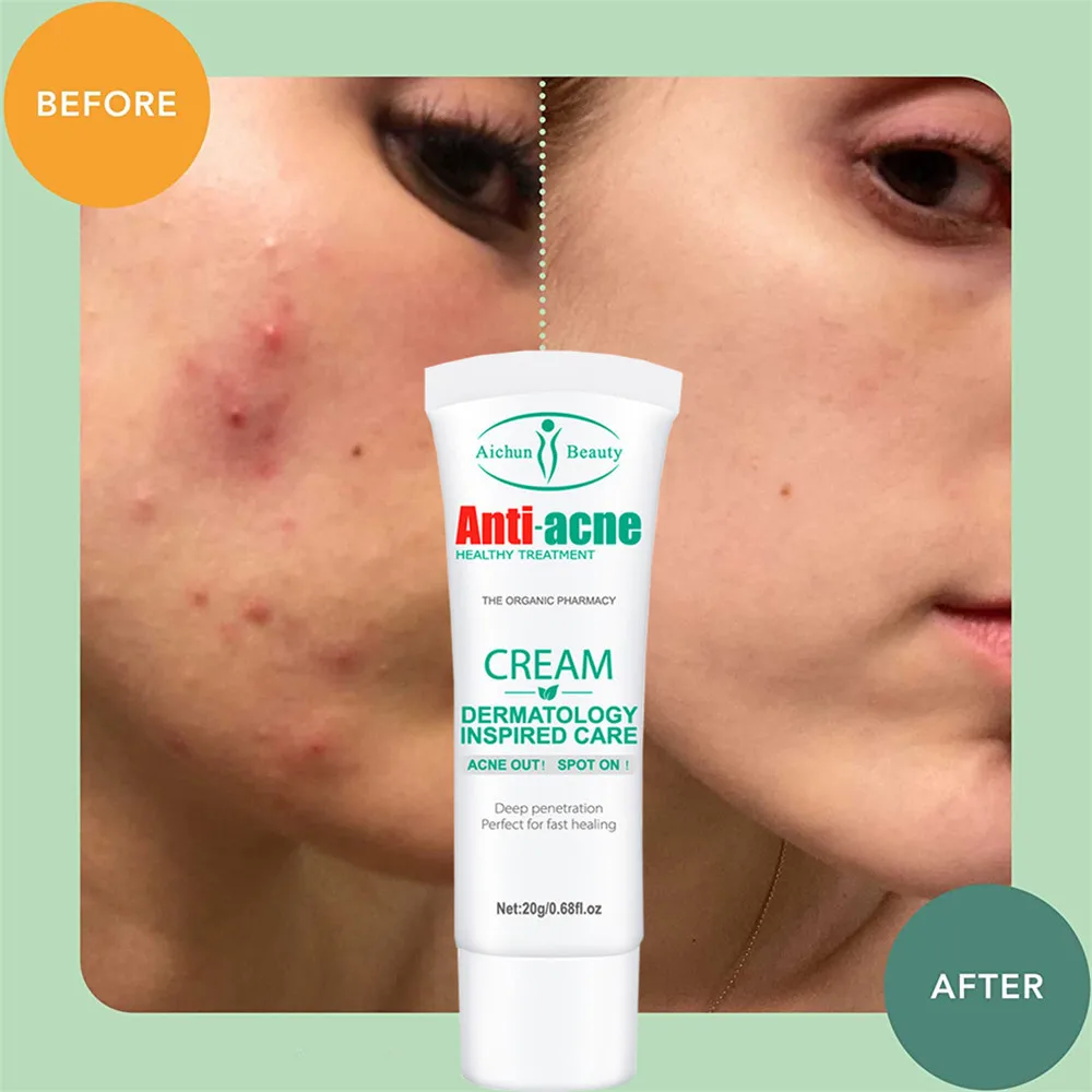 Plant Acne Removal Cream Acne Treatment Remove Acne Scars Fast Healing Whitening Pimples Marks Oil Control Face Care Moisturizer