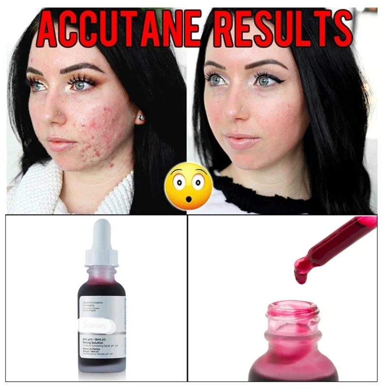 

Face Makeup Peeling Solution AHA 30% + BHA 2% Acne Removing Serum Repair Hyaluronic Acid Face Skin Care 30ml Original