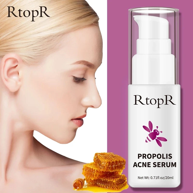Средство для лечения акне с прополисом 20 мл