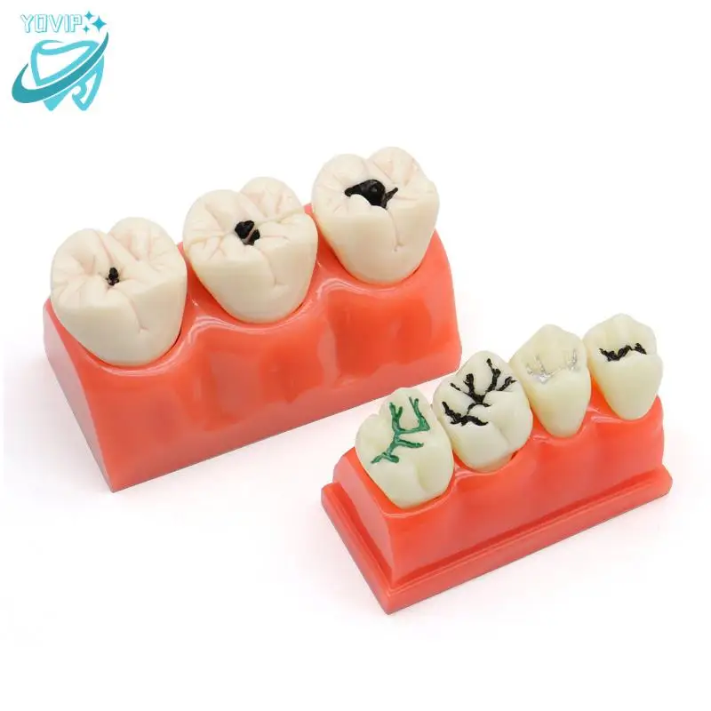 

Dental Implant Teach Crown Bridge Removable Model Porcelain Teeth Model Dental Demonstration Model For Dentist Teaching
