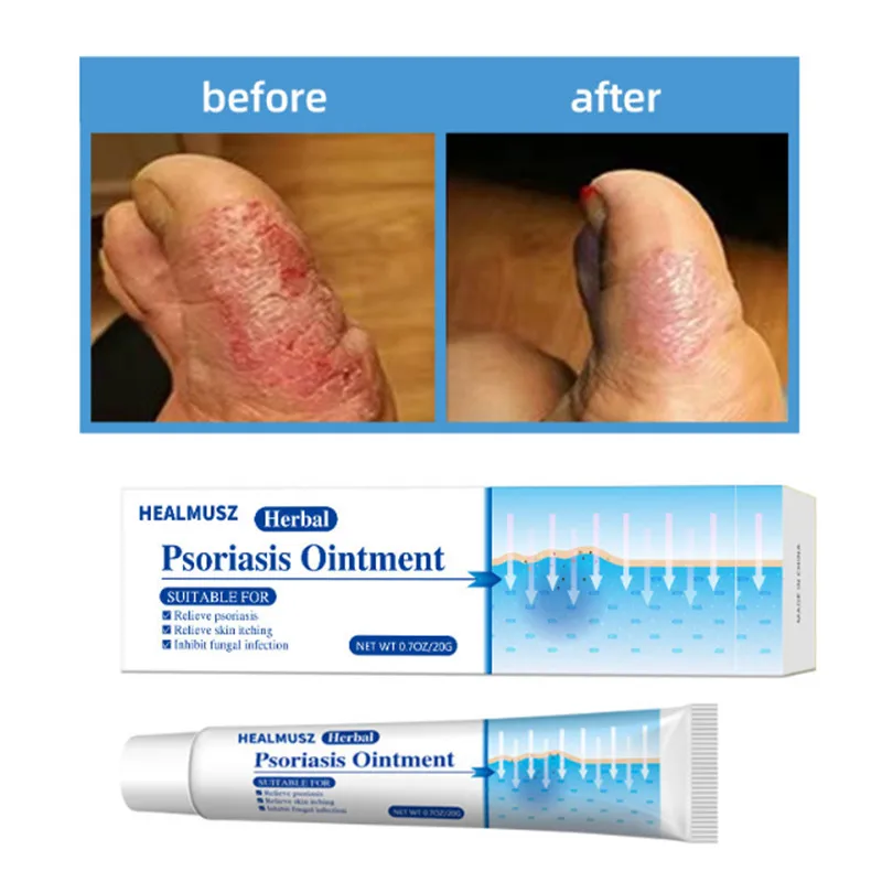 

Antibacterial Cream Psoriasis Ointment Herbal Treatment Fungus Eczema Anti-itch Relief Rash Urticaria Desquamation Body Care