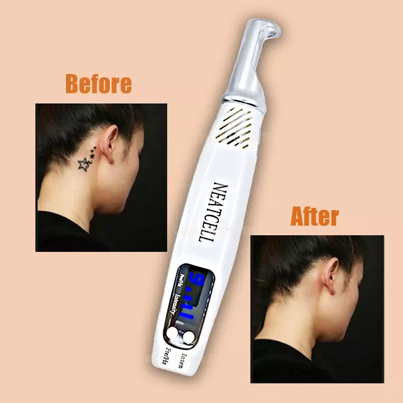 

Picosecond Laser Pen Tattoo Scar Removal Mole Acne Freckle Pigment Dark Spot Remover Gericht Doel Lokaliseren Positie Beauty Ski