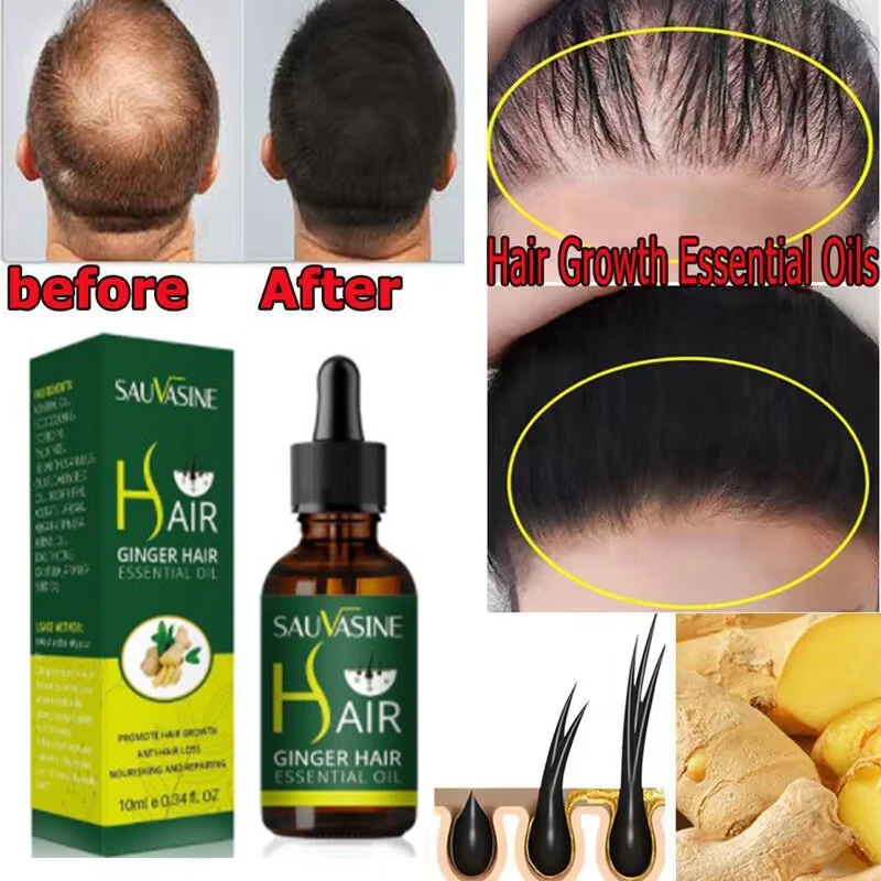 

Ginger Hair Growth Essential Oils Anti Hair Loss Product Prevent Baldness Treatment Scalp Repair Improve Dry Breaking Hair Care