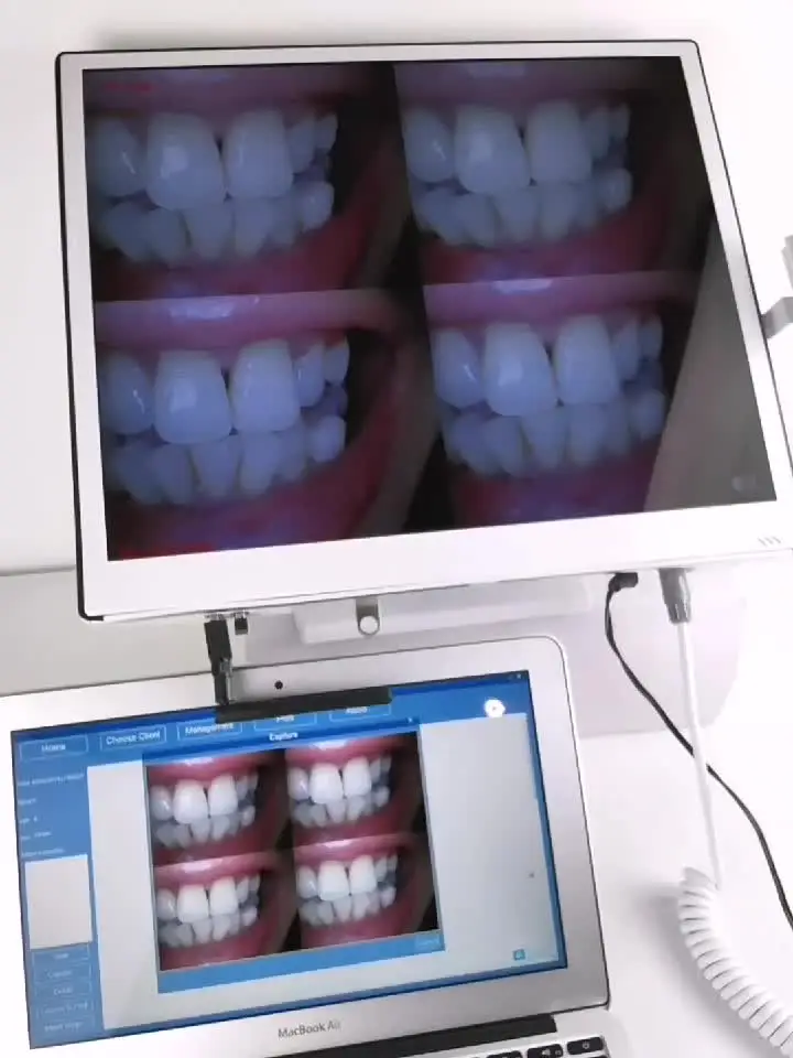 

5 Million Pixels tooth intra oral camera scanne intraoral 3d intra oral fort portable tooth unit