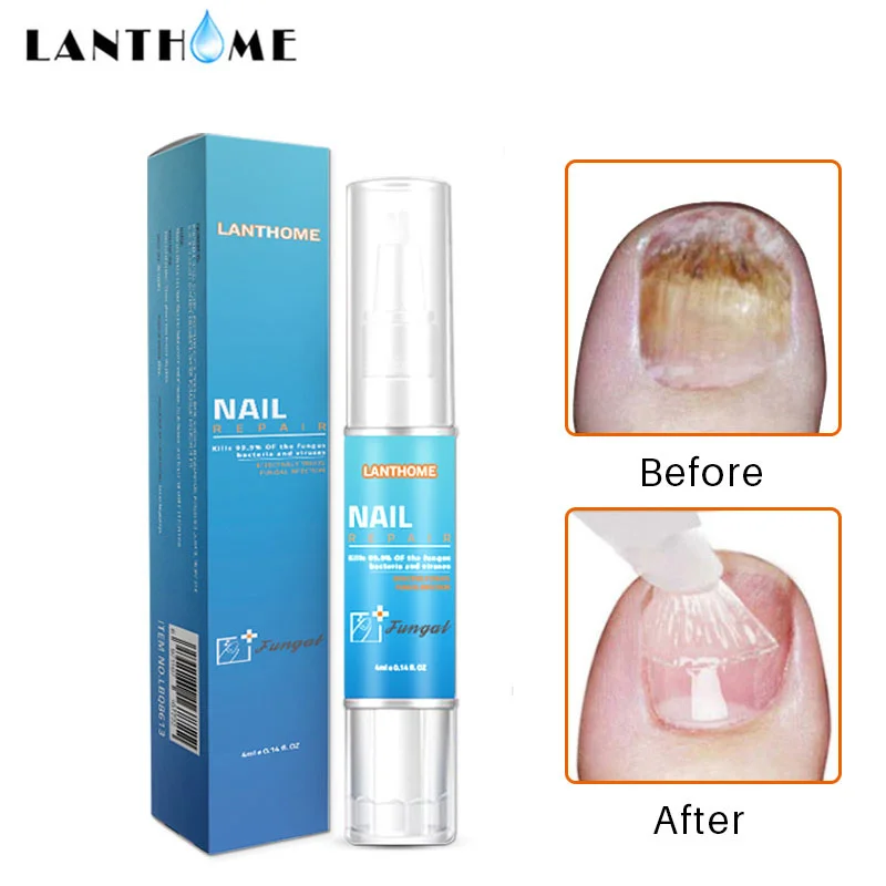 

Fungal Nail Treatment Pen Remove Onychomycosis Paronychia Fungal Nails Gel Anti Infection Herbal Toe Fungal Serum Foot Products