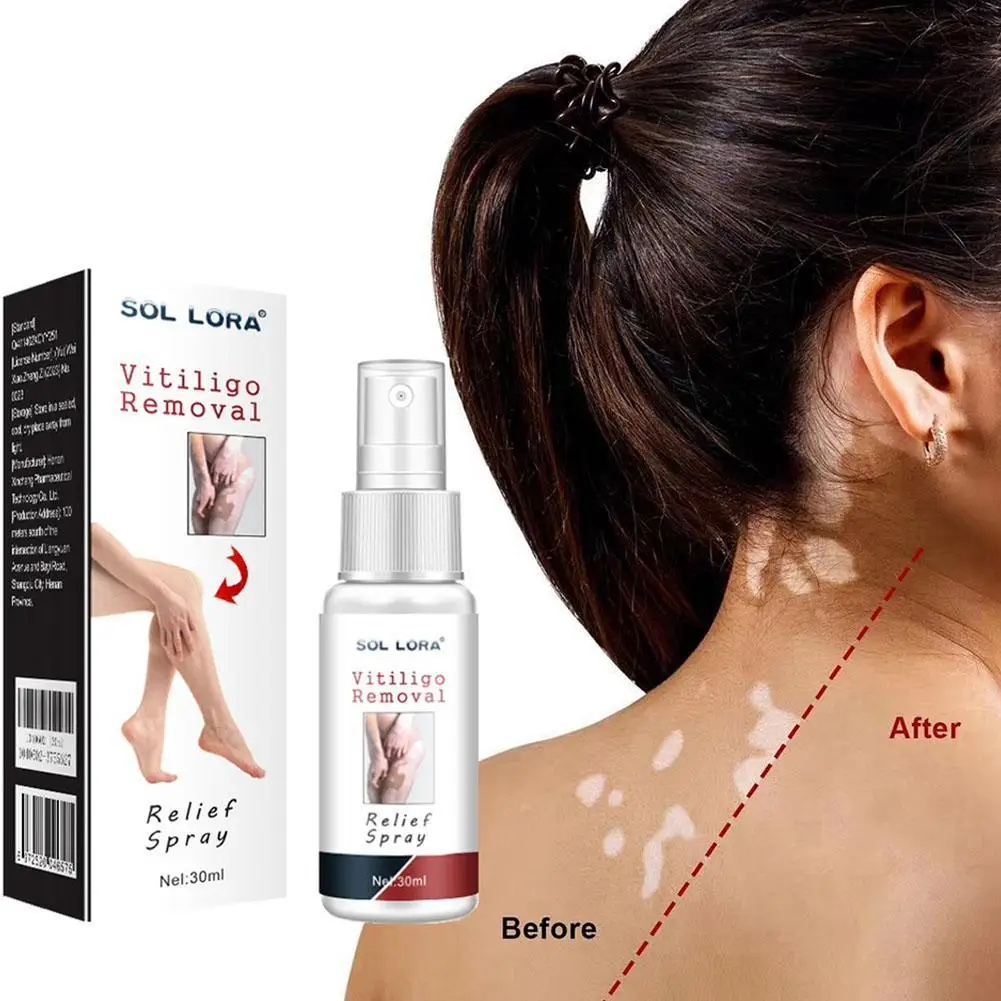 

30ml Vitiligo Relief Spray Skin Moisturizing Vitiligo Net Spray Skin Reduces Body Face Fades Vitiligo White Spots On Skin
