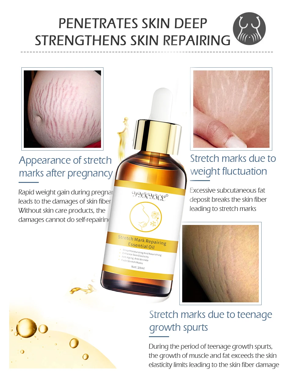 Средство для удаления растяжек, эфирное масло, крем для ухода за кожей ...