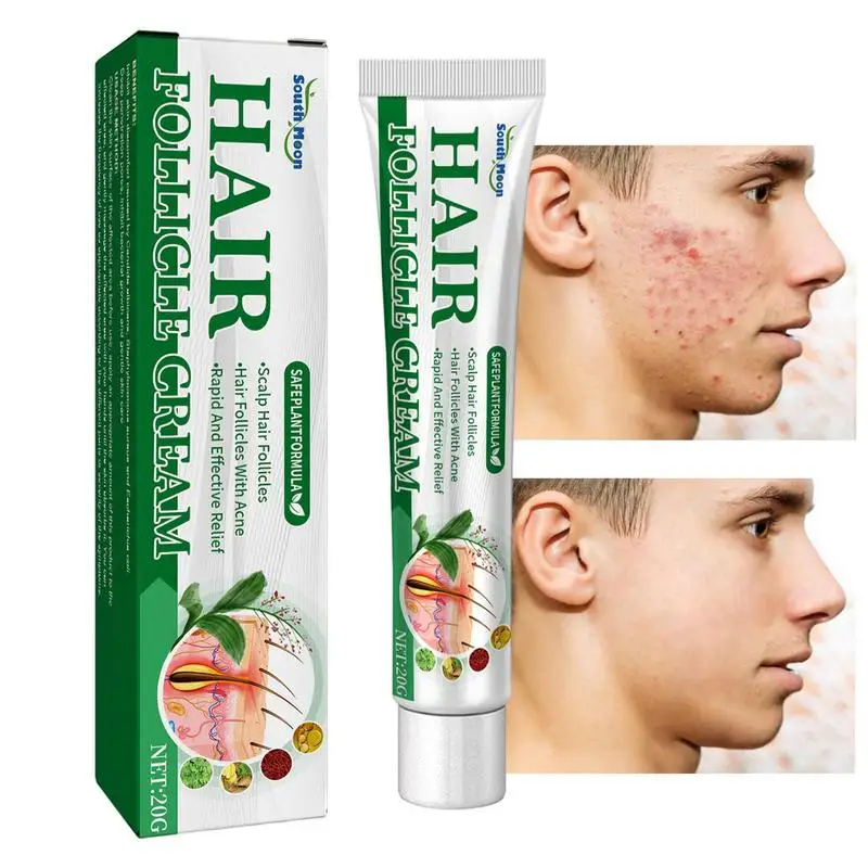 

Folliculitis Cream Scalp Hair Folliculitis Herbs Treatment Pustules Ulcers Medicine Spot Remover Skin Ointment Cysts Papules