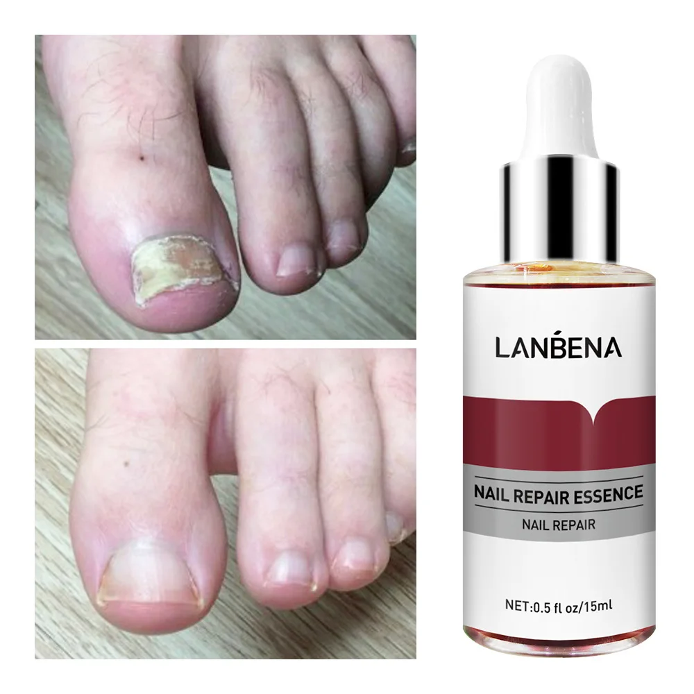 

Fungal Nail Repair Essence Serum Care Finger Toe Anti Nail Repair Footcare Fungal Nail Treatment Liquid
