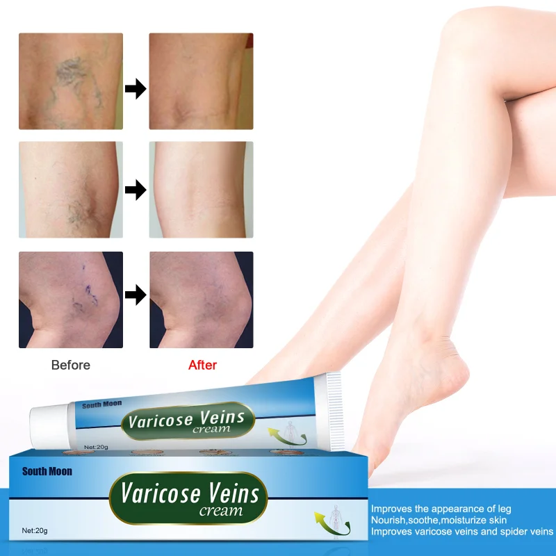 

ointment varicose veins Earthworm Leg Blue Tendon varicose vein relief cream relieve vasculitis phlebitis spider pain Repair