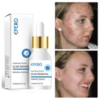effective acne removal face serum treatment acne scars fade acne anti acne shrinks pores oil control whitening beauty products