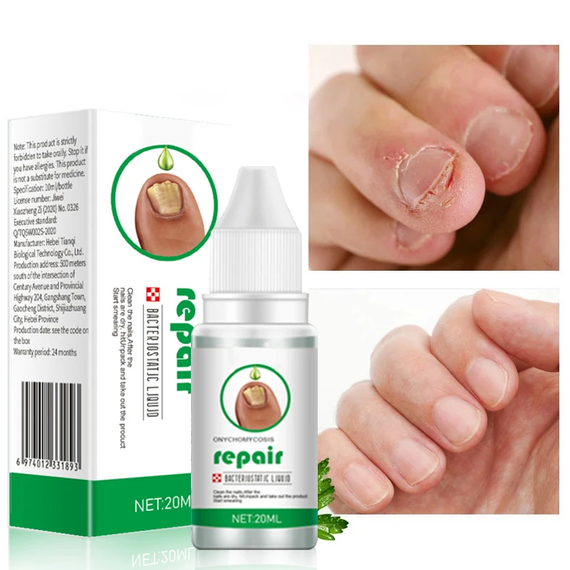 

Nail Fungus Treatment Serum Toe Fungal Repair Products Hand Foot Care Removal Gel Anti Infection Onychomycosis Paronychia