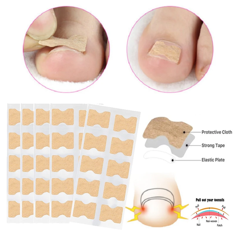 

10/20/50 Pcs Nail Correction Stickers Ingrown Toenail Corrector Patches Paronychia Treatment Recover Corrector Pedicure Tools