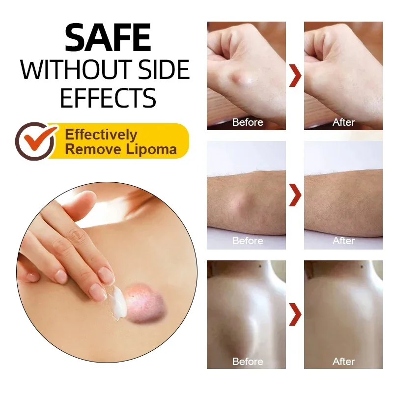 Крем Lipoma для удаления жира 20 г