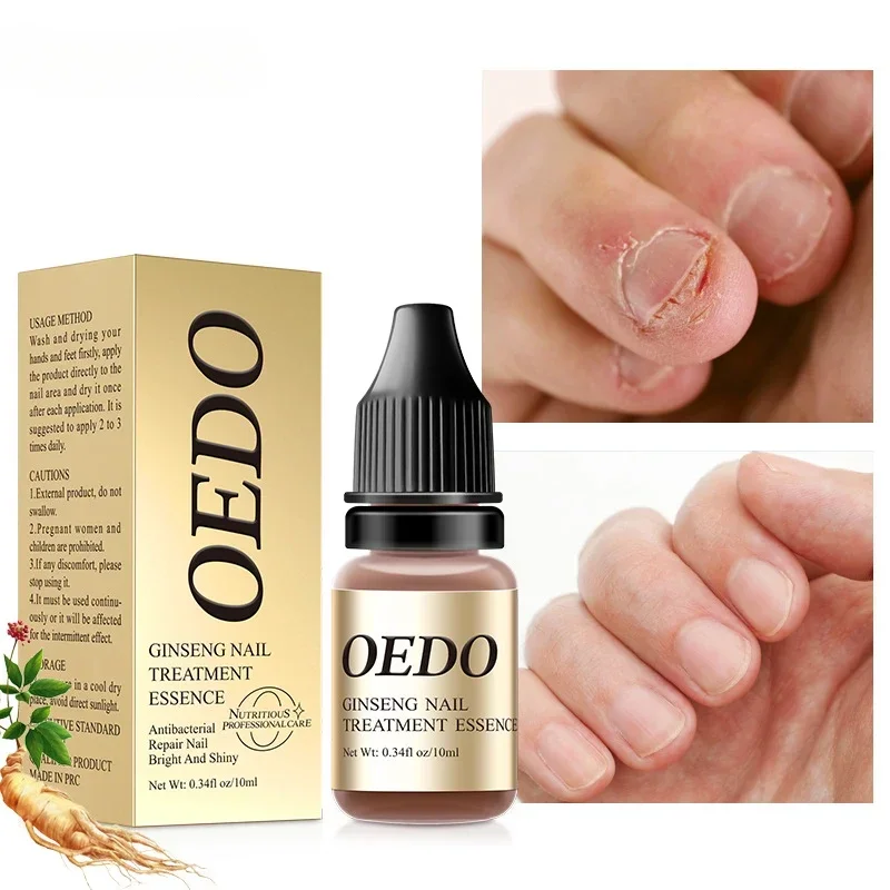 

Herbal Nail Fungus Treatments Serum Foot Nail Repair Essential Oil Tools Toe Nail Antibacterial Care Healthy Nail Strengthener