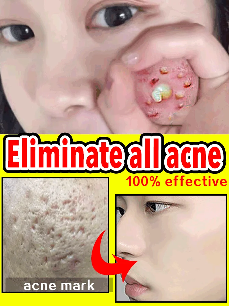 

Acne Treatment Cream Anti -aging Pimples Black Spot Removal Gel Anti-task Acne lotion Scar Stain Remove Ointment Facial Serum