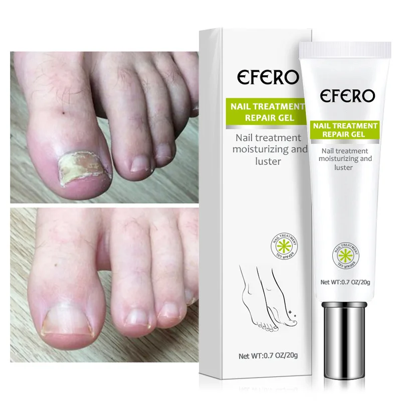 

20g Fungal Nail Treatment Serum Toenail Fungus Removal Liquid Onychomycosis Treatment Repairing Nail Essence Hand Foot Care