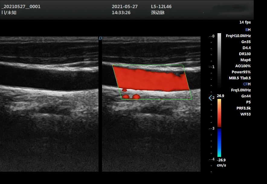 15-дюймовый светодиодный ультразвуковой аппарат для человеческого Ecografo Portatil 2D Color