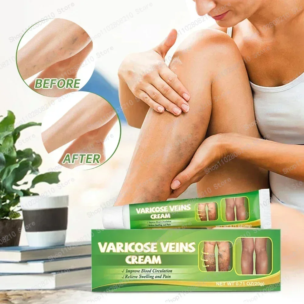 Оригинальное средство для снятия варикозного расширения вен