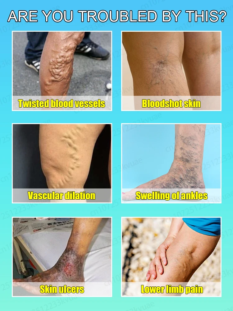 Мазь от варикозного расширения вен 7-дневное лечение опухших кровеносных сосудов