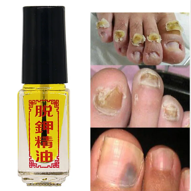 3 Days Effective Fungus Treatment Removal of Onychomycosis Paronychia Anti Fungal Nail Infection Serum Toe Nail Fungus Oil Care