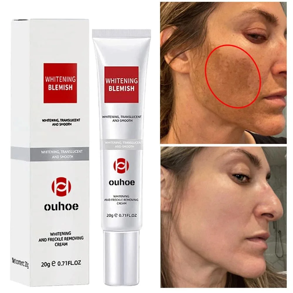 Powerful Whitening Freckle Cream Remove Acne Spots Melanin Dark Spots Face Lift Firm Face Cream Skin Care Beauty Korea Cosmetic