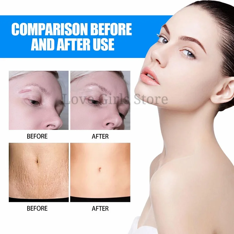 

Acne Scar Removal Cream Pimples Stretch Marks Face Gel Remove Acne Smoothing Whitening Body Skin Care Pigmentation Corrector