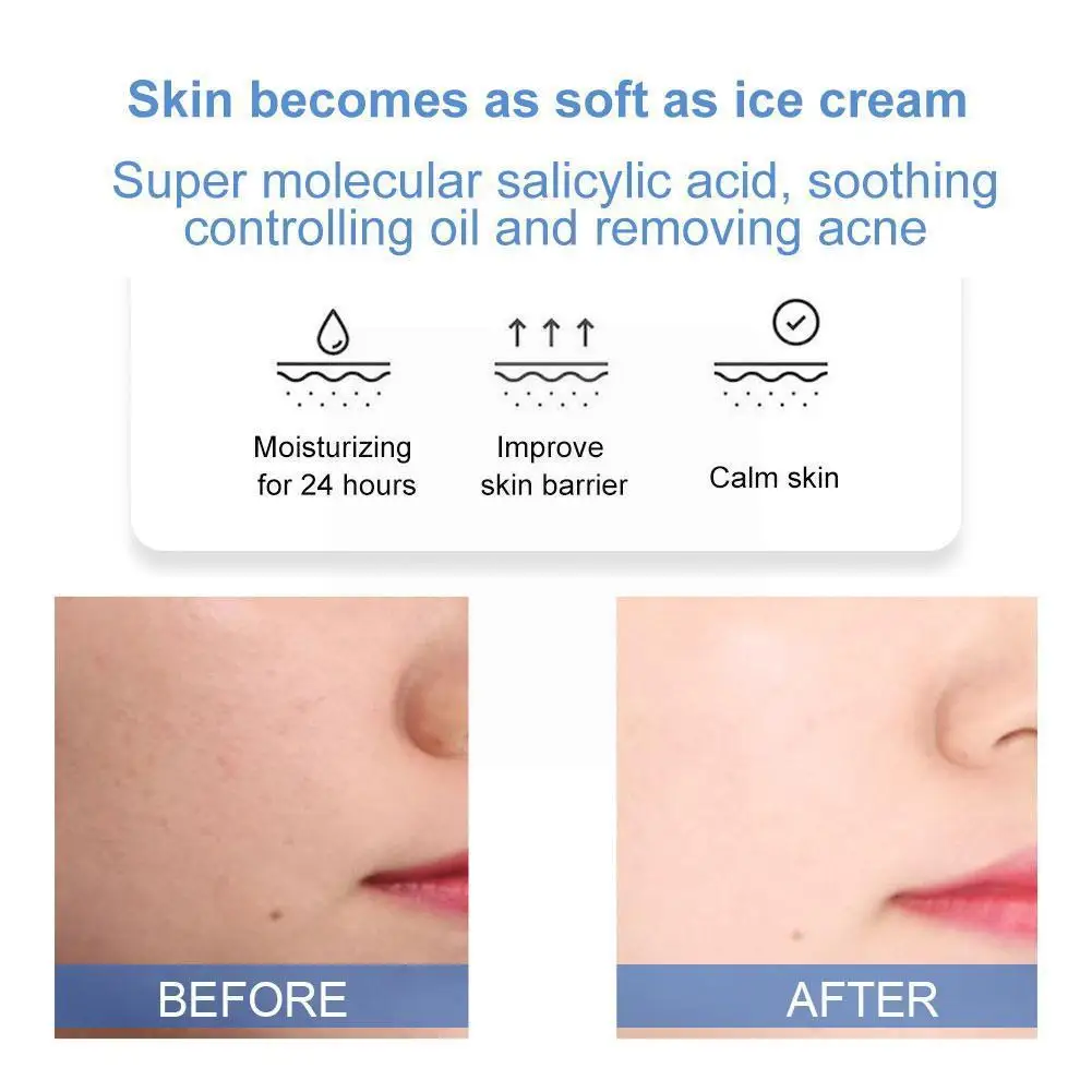 

Salicylic Acid Ice Cream Tube Set To Reduce Acne Blackheads Moisturizing And Marks D3v9