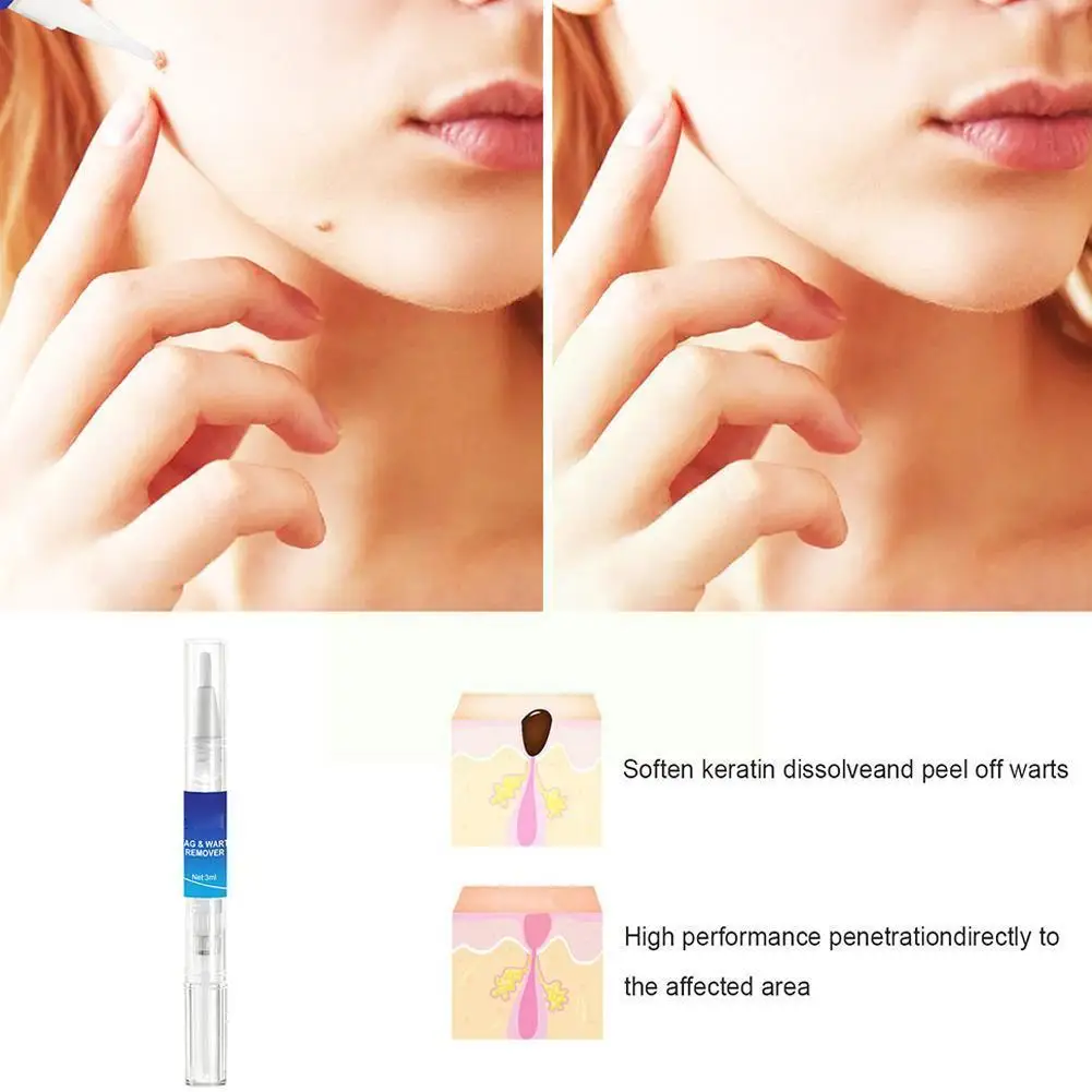 

Removing Against Moles Liquid Pen Treatment Papillomas Warts Anti Of Liquid Remover Tags Remedy Skin Verruca From Removal J6b0