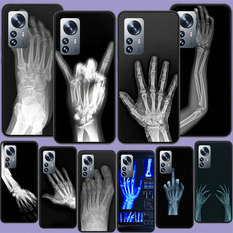 

Autumu X ray Hand Bones Phone Case For Xiaomi Mi 13 12T Pro 12X 12 Lite 5G 11T 11i 11 Ultra 10 10T 9T Pro 9 8 6X 5X A1 A2 Capa C