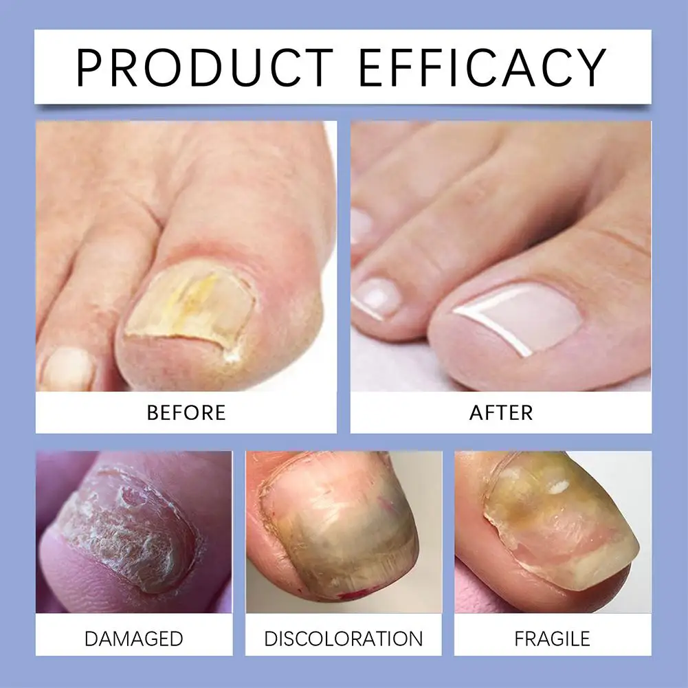 Лечение грибка ногтей эфирное масло средство для удаления на ногах против ухода