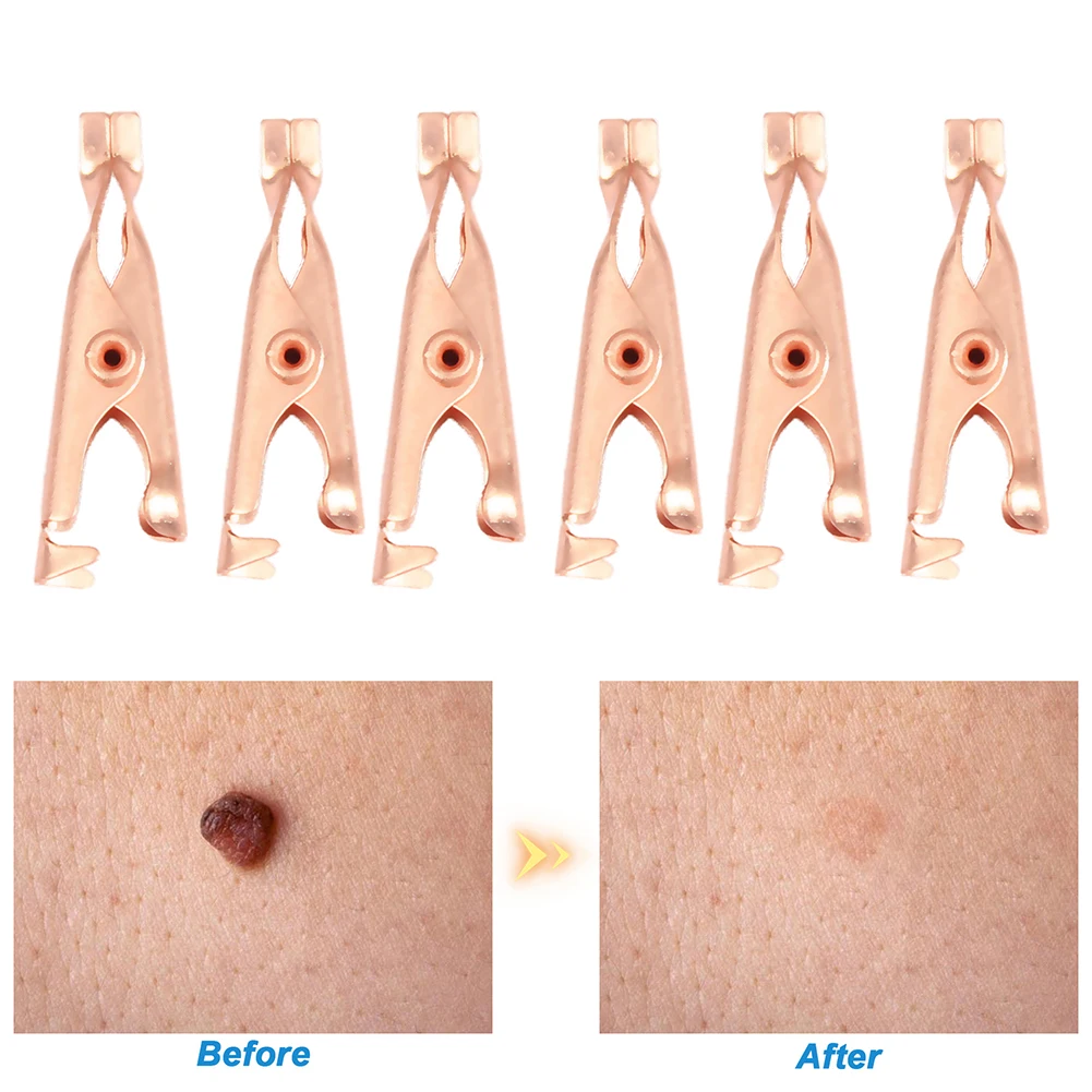 2/6 шт. безболезненная бирка для кожи клипсы удаления родинок бородавок лечение