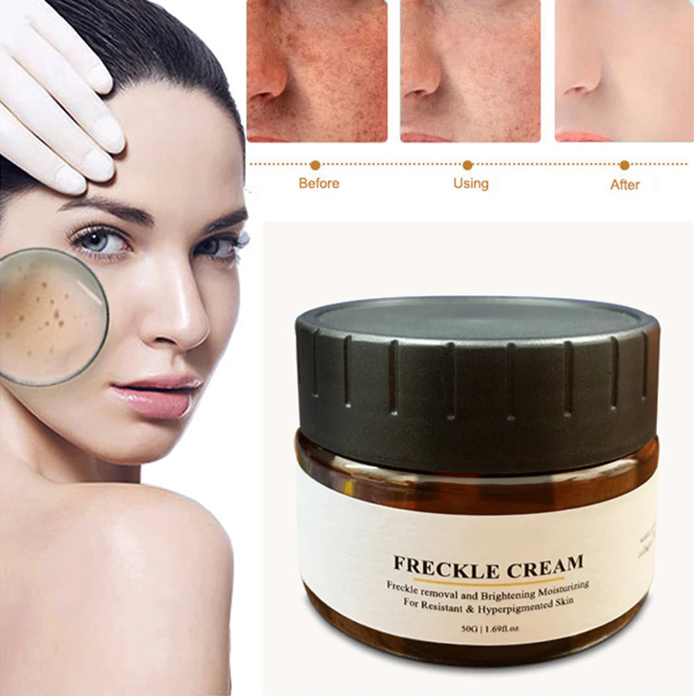 

Freckle Removal Cream Sunburn Removal Cream Moisturizing Whitening Cream