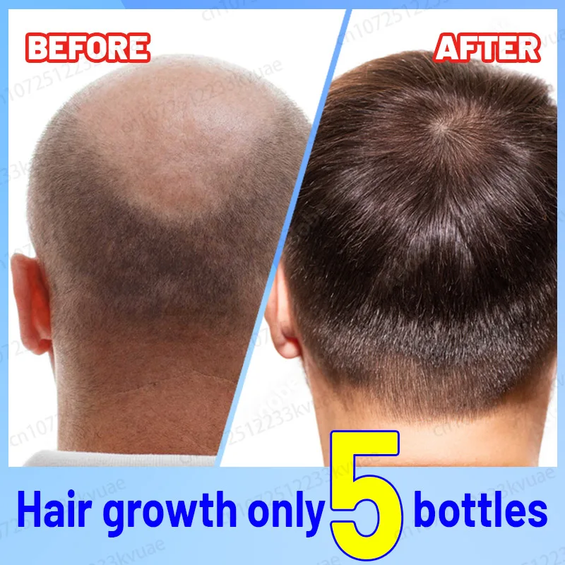 

Powerful hair growth Anti-hair loss Anti-baldness Fast hair growth Hair loss treatment Hair regrowth Fast Hair Growth Oil