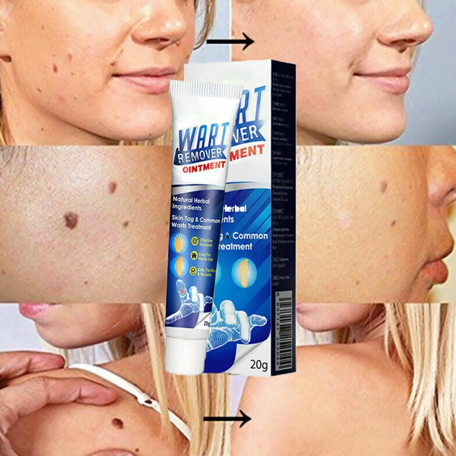 

20g Mole & Skin Tag Removal Ointment Warts Remover Cream Herbal Skin Dark Spot Treatment Mole Safely Care Corn Skin Plaster O8Y8