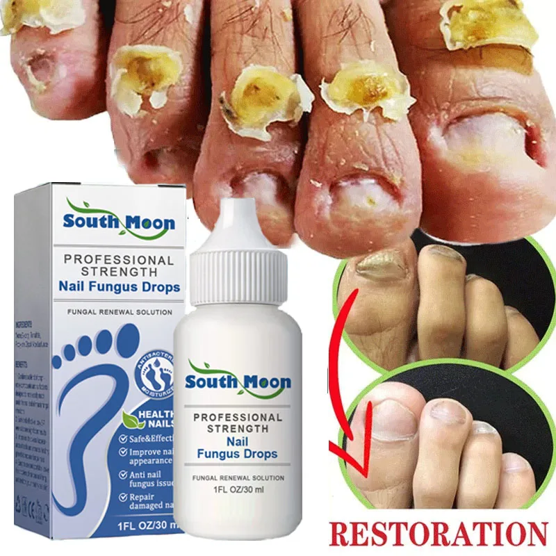 

Nail Fungus Treatment Remedy Serum Foot Fungal Removal Paronychia Onychomycosis Anti Infection Feet Repair Health Care Products