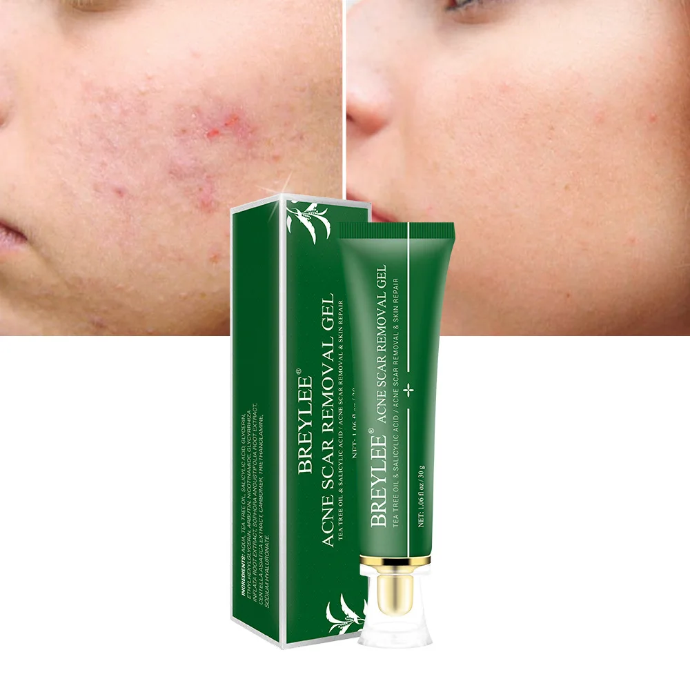 BREYLEE Acne Scar Removal Gel Fade Acne Marks Spots Remove Skin Pigmentation Soothing Prevent Acne Treatment Serum Essence 30g