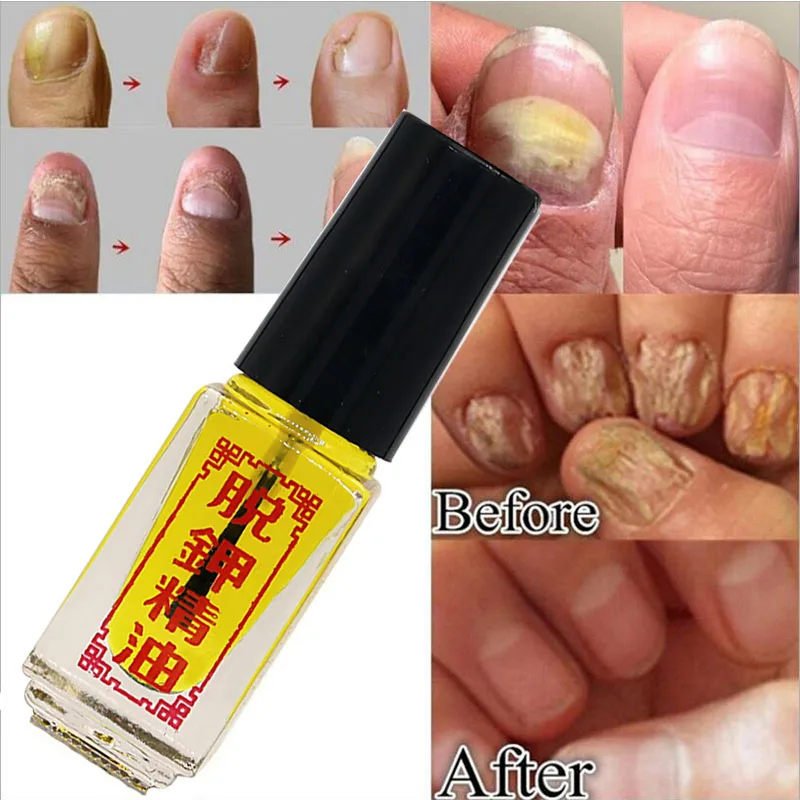 

Toe Nail Fungus Oil 3 Days Effective Fungus Treatment Removal of Onychomycosis Paronychia Anti Fungal Nail Infection Serum Care