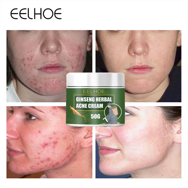 

Herbal Acne Remover Cream Effective Anti-acne Pimple Treatment Fade Acne Marks Gel Shrink Pores Oil Control Moisturizing Product