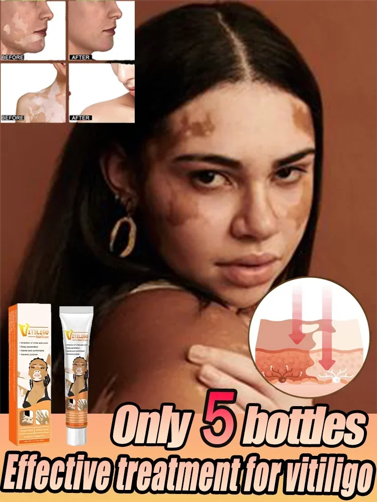 Vitiligo Skin Cream Help Treatment Melanin Promotes Pigmentation Mela Gain