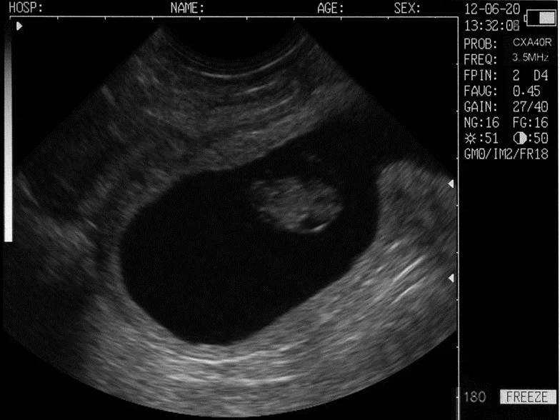 Ультразвук для использования Fram Ветеринарный ультразвуковой сканер Bmv L60