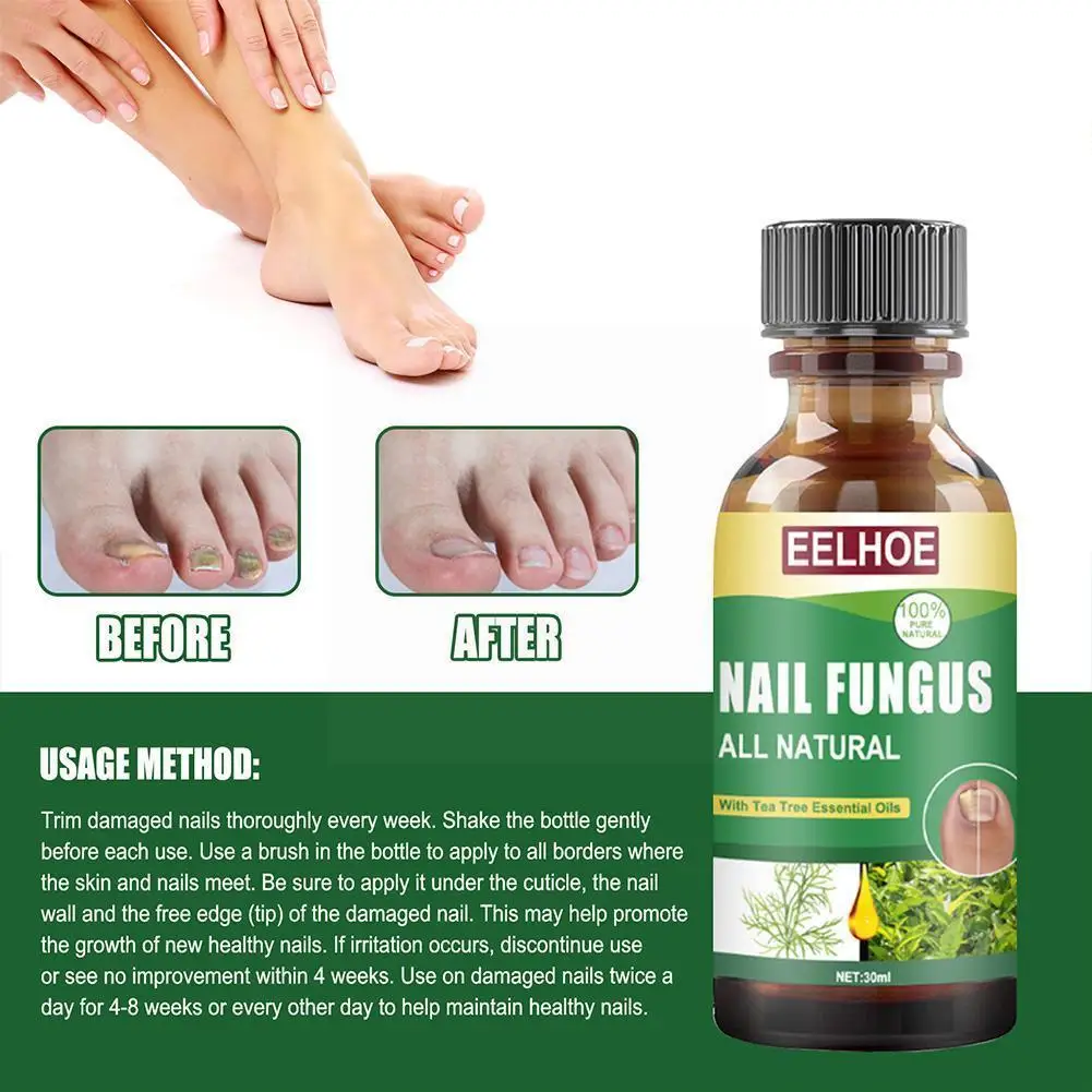 

Nail Fungal Treatment Care Essence Nail Foot Whitening Infection Gel Onychomycosis Removal Paronychia Fungus Anti Nails W4Y3