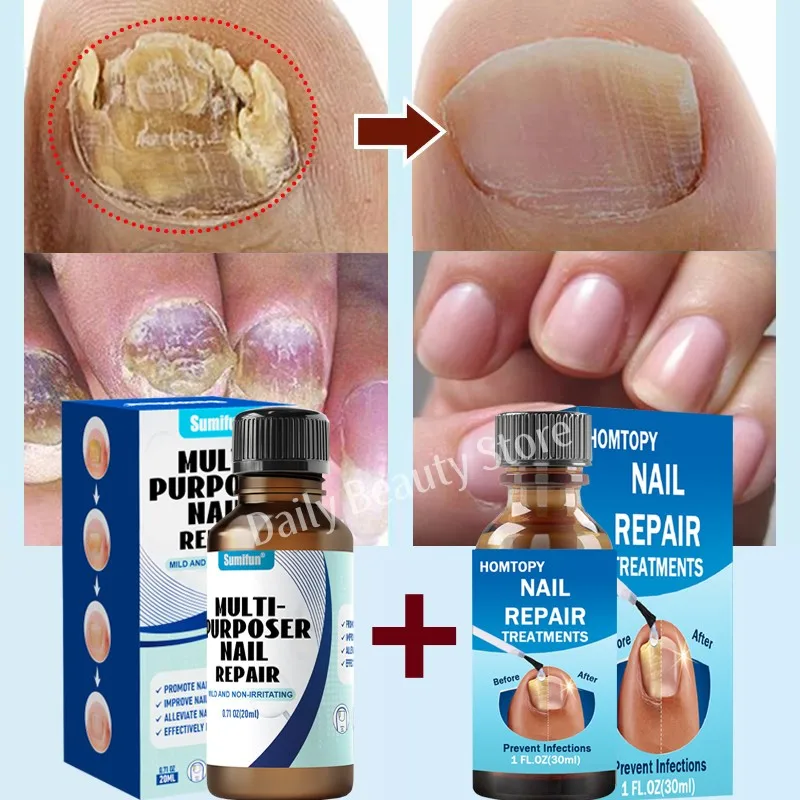 Сыворотка для лечения Ногтей от грибков восстанавливающий гель ногтей удаление