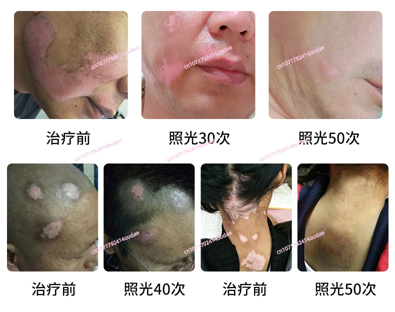 Медицинское устройство для фототерапии vitiligo домашнее лазерной терапии с