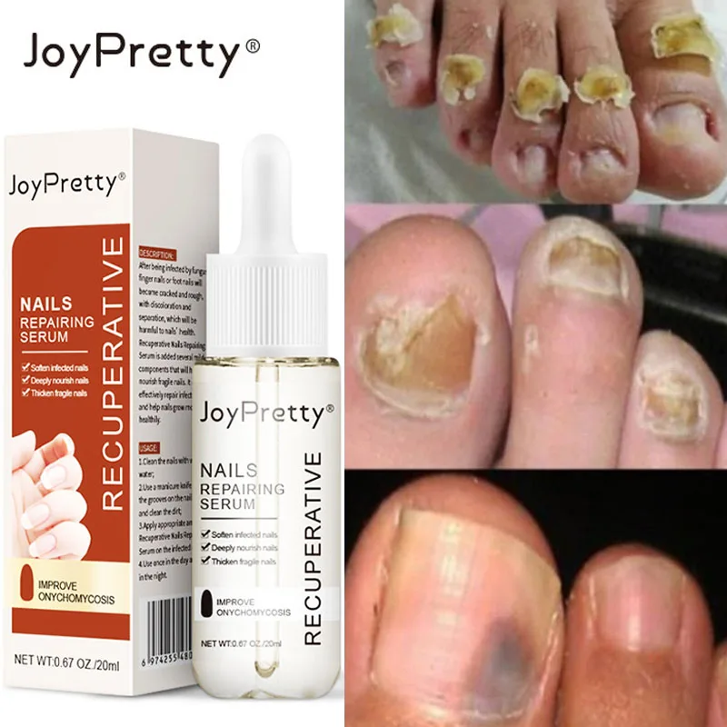 20ml Treatment Nail Fungus Serum Feet Care Anti Infection Paronychia Onychomycosis Essence Hand Foot Nail Fungus Removal Liquid