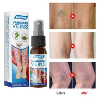 30ml varicose vein soothing spray relieve leg swelling pains varicose veins treatment spray for vasculitis phlebitis health care